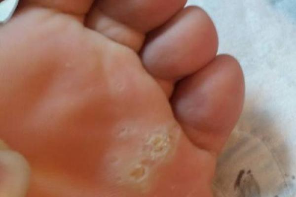揭秘脚底黑点的含义：如何解读你脚下的秘密命运