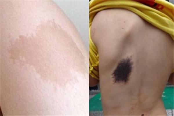 探秘命理：屁股左边胎记的神秘含义与人生影响