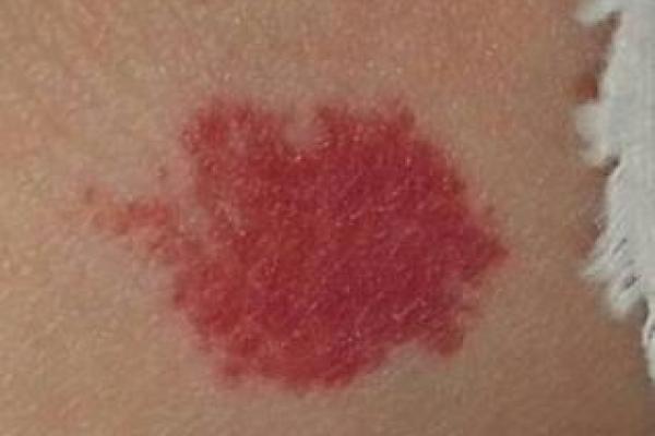 探秘命理：屁股左边胎记的神秘含义与人生影响