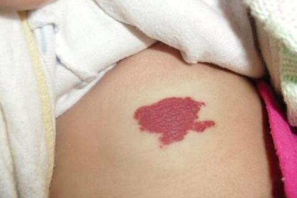 揭秘方形胎记:它们预示着哪些命运轨迹? 揭秘方形胎记:它们预示着哪些命运轨迹?