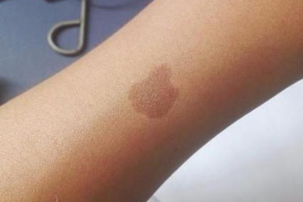 揭秘方形胎记:它们预示着哪些命运轨迹? 揭秘方形胎记:它们预示着哪些命运轨迹?