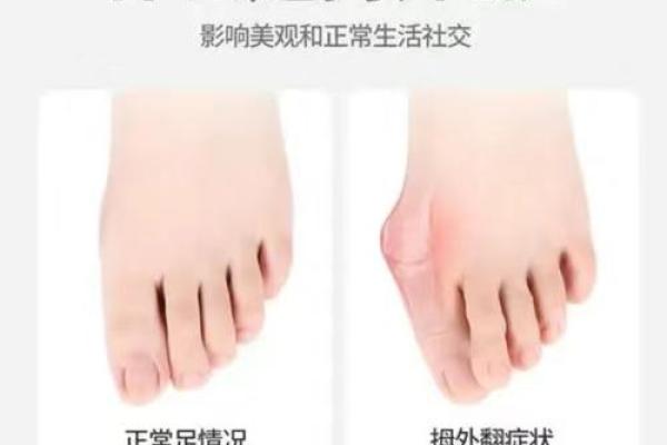 揭开脚畸形外翻的神秘面纱：症状、成因与恢复之路