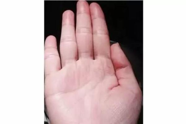 大拇指粗短，每个人的命运都是独特的！