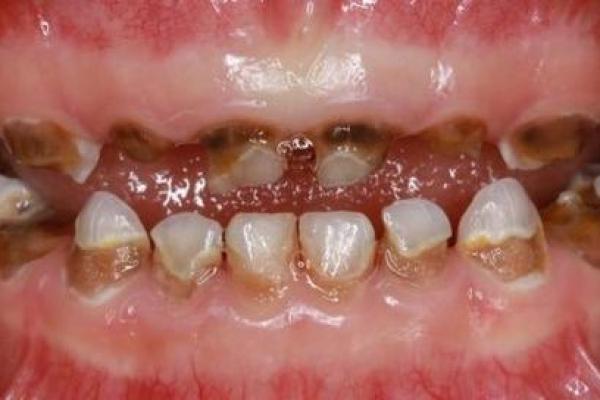 牙齿下牙小,命运与健康的密切联系 牙齿下牙小,命运与健康的密切联系