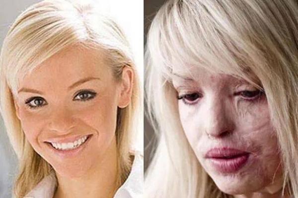 从小毁容的人:命运的黑暗与光明交织的旅程 从小毁容的人:命运的黑暗与光明交织的旅程