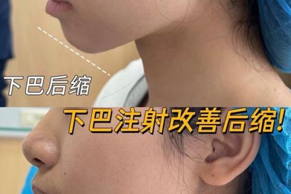 探索完美下巴：打造您理想面容的秘密