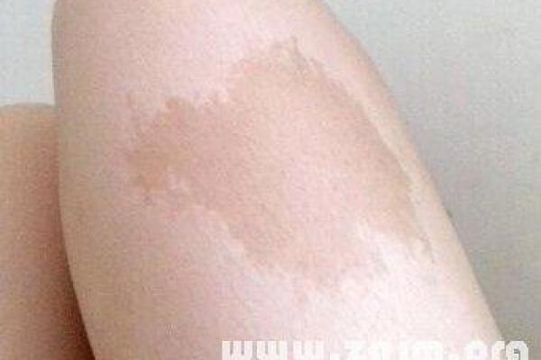 女孩有胎记的命运解析：藏着神秘的命理之门