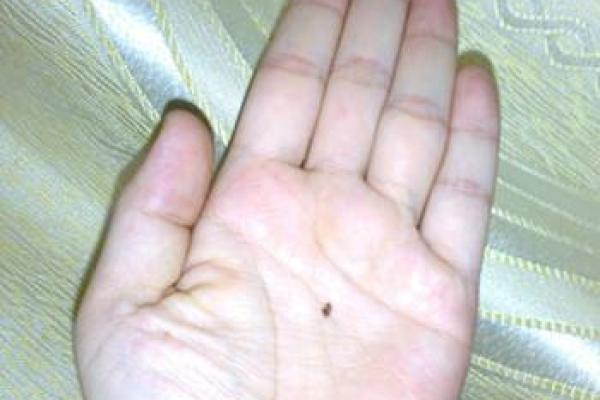 掌中有痣，命运之谜：手相学揭秘痣的位置与命理关系