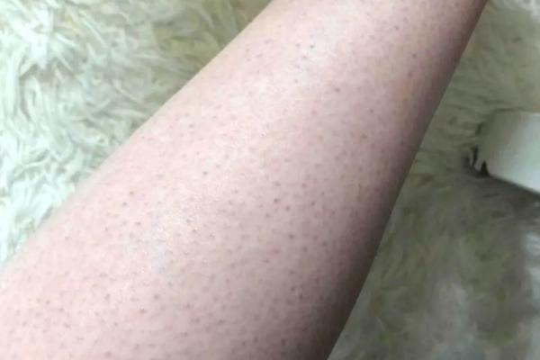 有鸡皮肤的人命运揭秘：从皮肤现象看人生走向