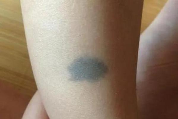 肚子上的胎记纹，揭示你的命运玄机与人生轨迹！