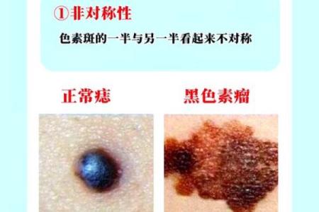 身上的痣与命运的秘密：探寻痣相学的神秘世界